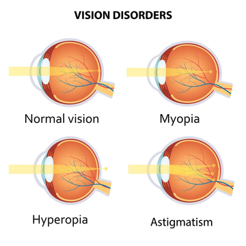 Understanding Refractive Errors